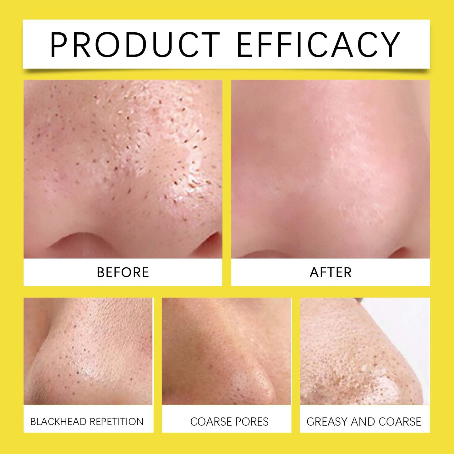Hoygi Hydrocolloid Nose Patch, Hydrocolloid Invisible Concealer To Remove Blackheads And Acne Facial Pore Cleaning Nose Patch