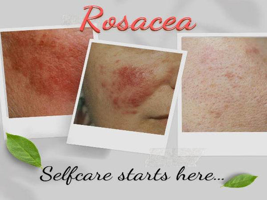 Organic Wash for Rosacea Prone Skin - For Women & Man