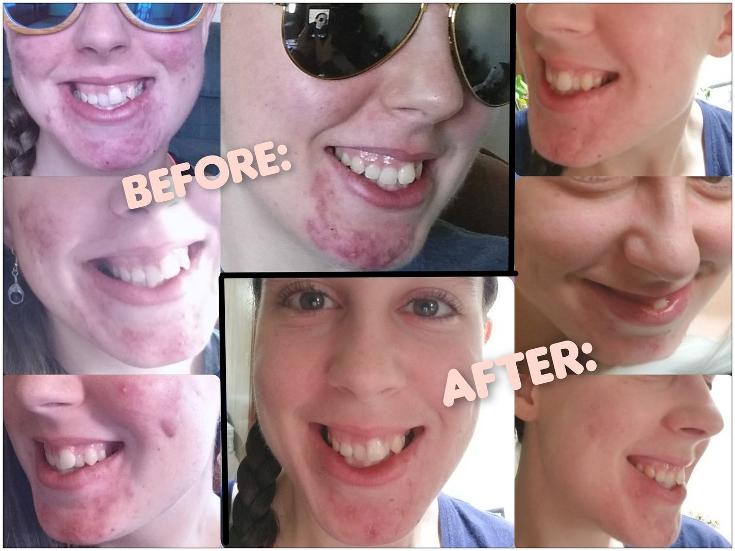 Scar Lifting Serum