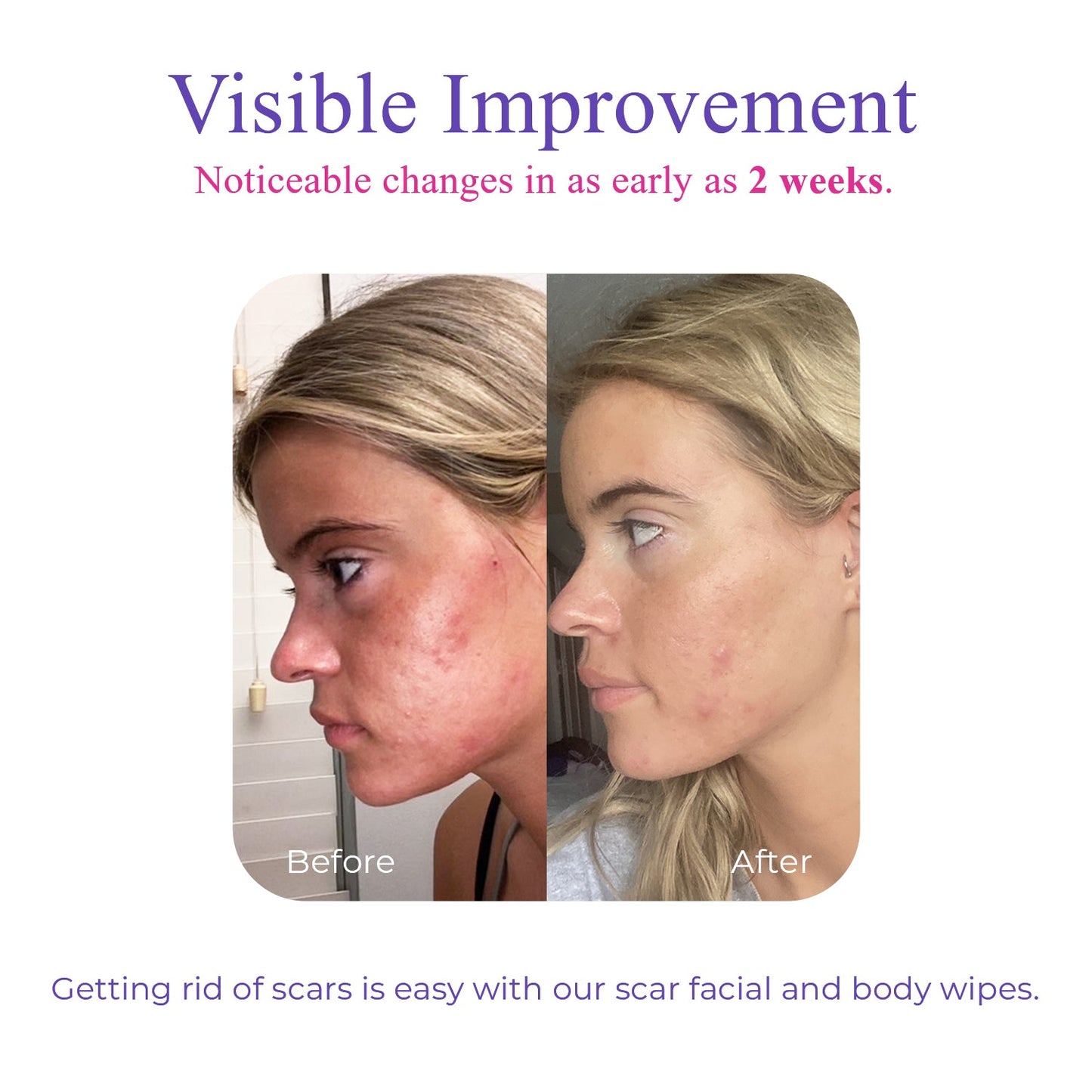 Derminish® Scar Wipes