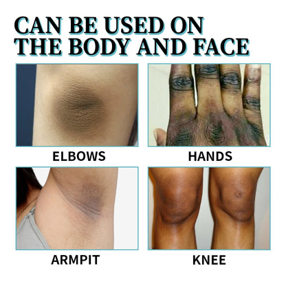 OUHOE Acanthosis Nigricans Therapy Lotion, Skin Moisturizing Clean Black Dark Heavy Alar Knee Joint Repair Carry Bright Color Of Skin