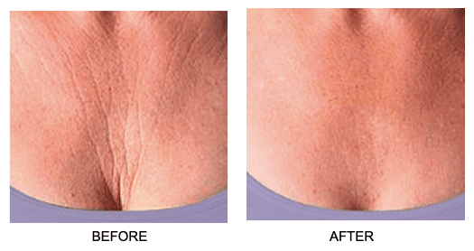 Skin Plumping Chest Mask [Reusable]