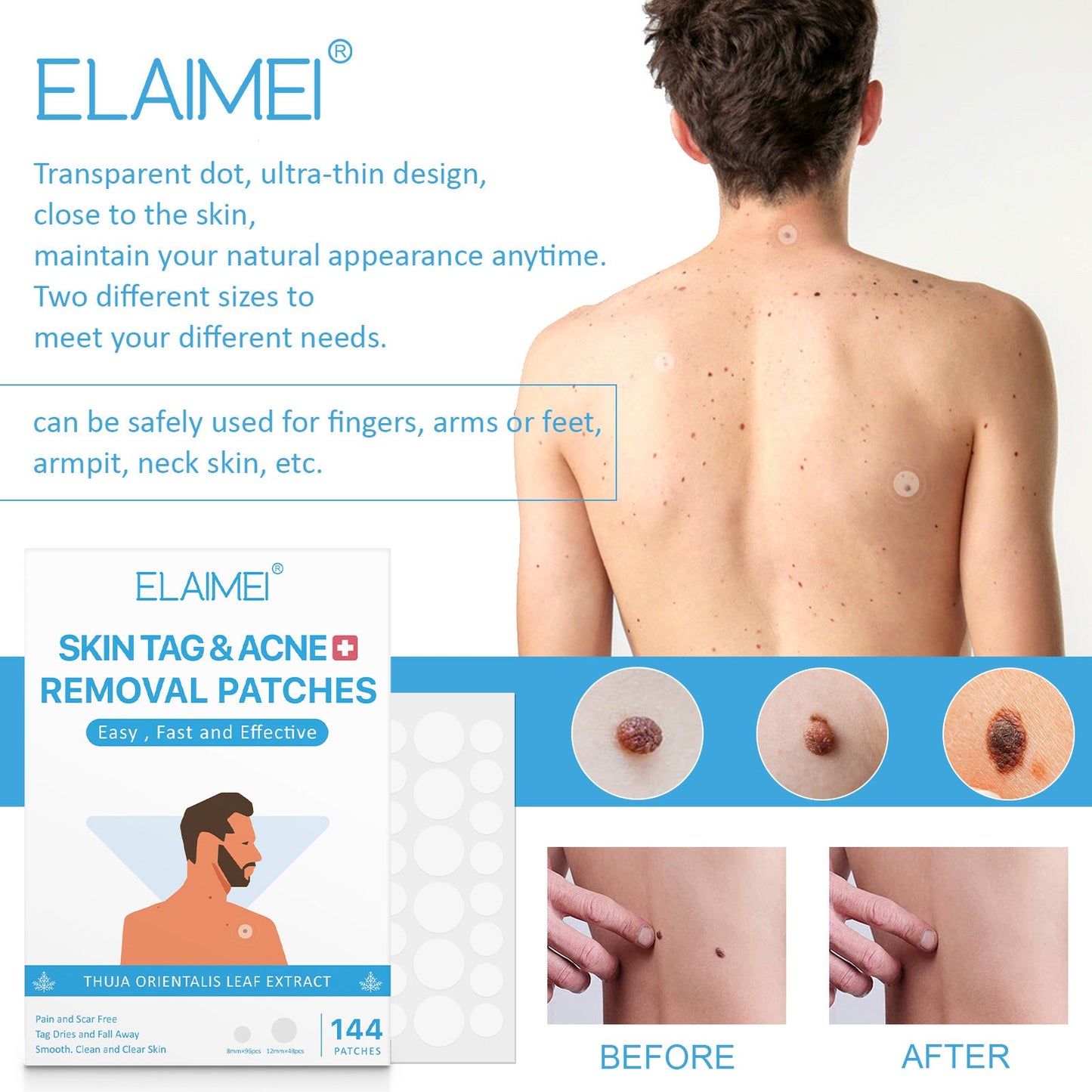 New Skin Tag Remover Patches Skin Tag Remover Pads Covers Conceals Skin Tags Mole Wart Removal Patches Fast Deliver