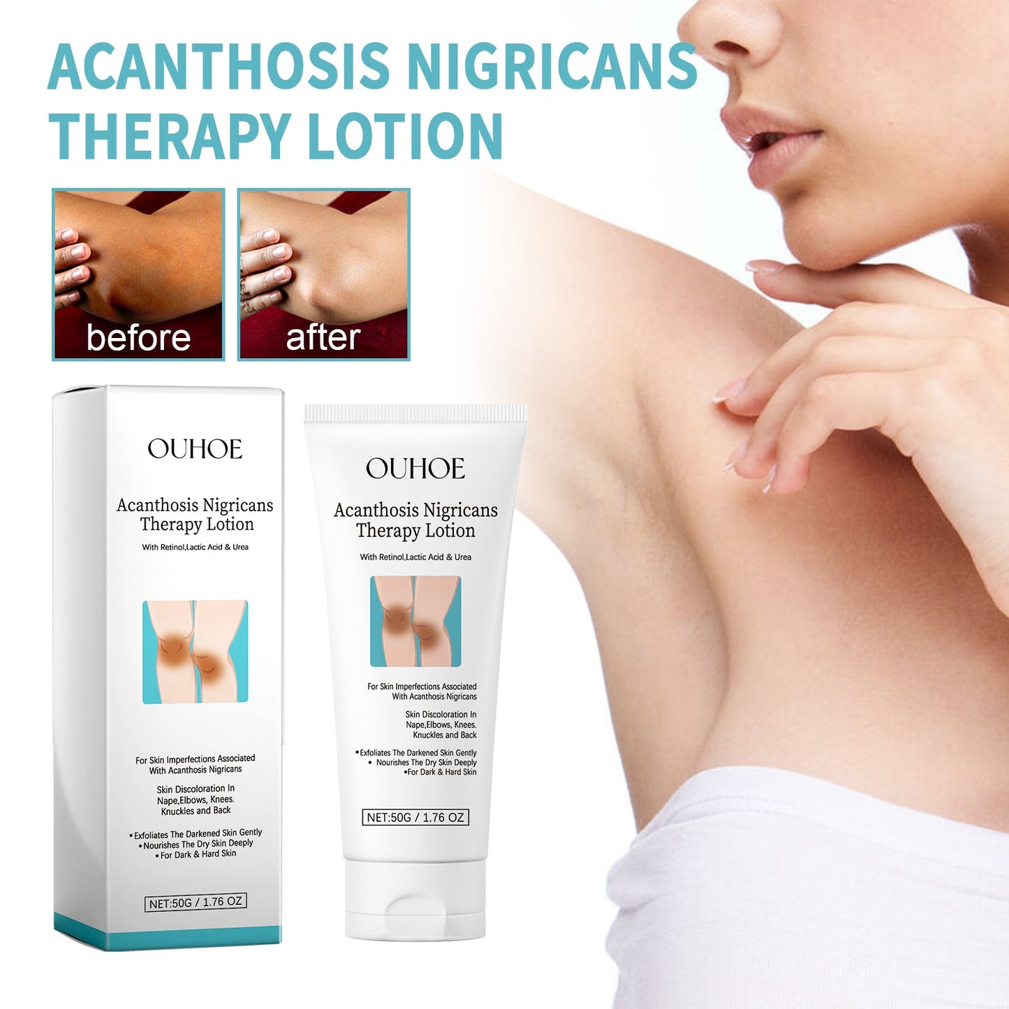OUHOE Acanthosis Nigricans Therapy Lotion, Skin Moisturizing Clean Black Dark Heavy Alar Knee Joint Repair Carry Bright Color Of Skin