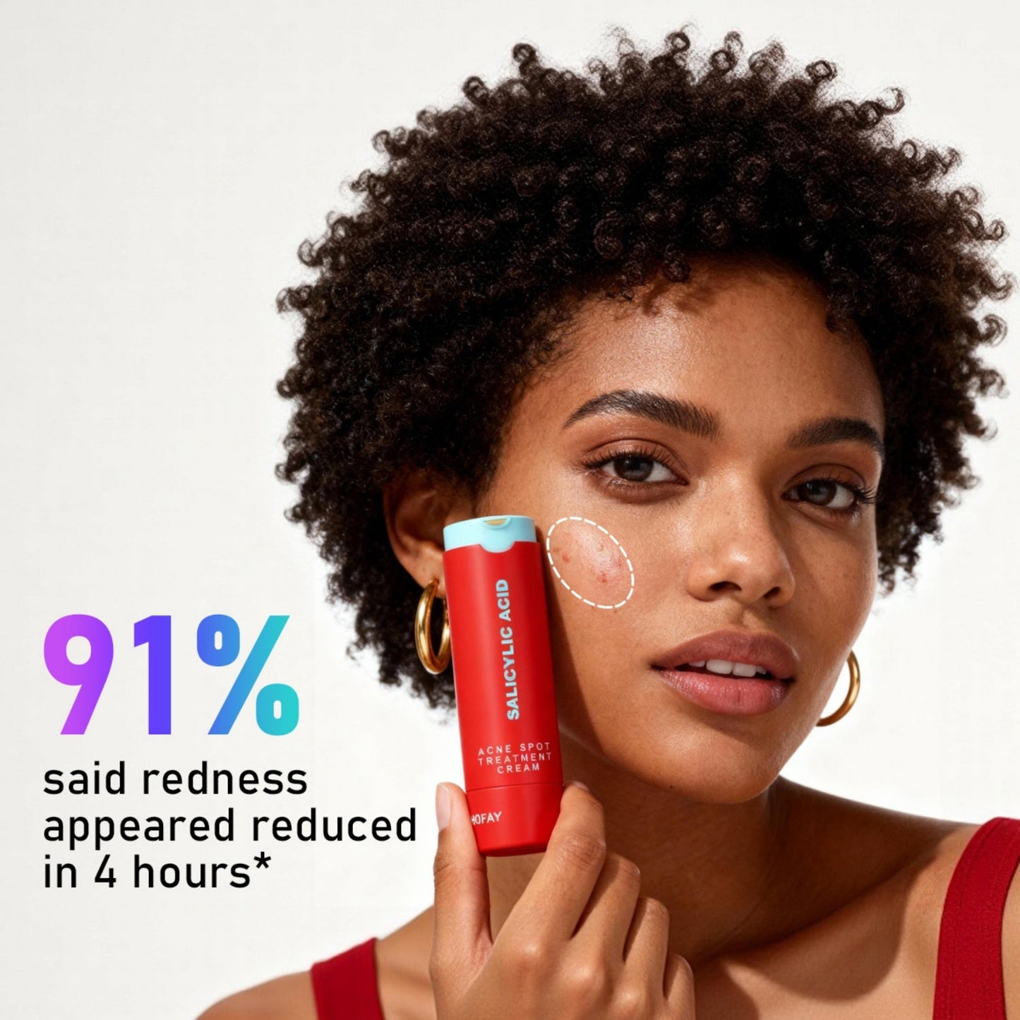 Phofay Acne Removing Lotion
