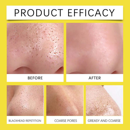 Hoygi Hydrocolloid Nose Patch, Hydrocolloid Invisible Concealer To Remove Blackheads And Acne Facial Pore Cleaning Nose Patch