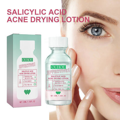 OUHOE Salicylic Acid Acne Lotion Gently Cares For Acne-Prone Skin, Refines Pores And Moisturizes Facial Skin