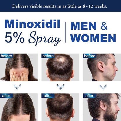 OSIMOON Minoxidil Spray With Biotin Hair Growth Serum