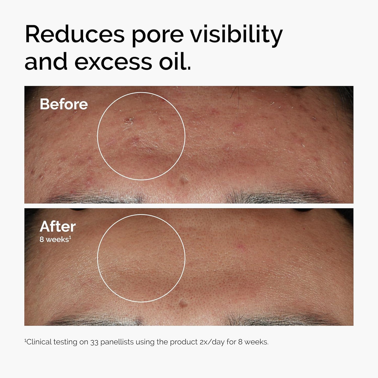 THE ORDINARY High-Strength & Blemish Serum