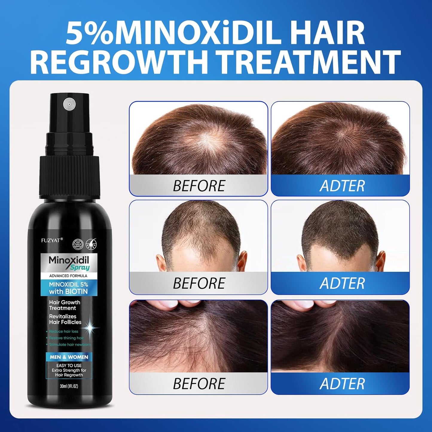 MINOXIDIL Hair And Beard Growth