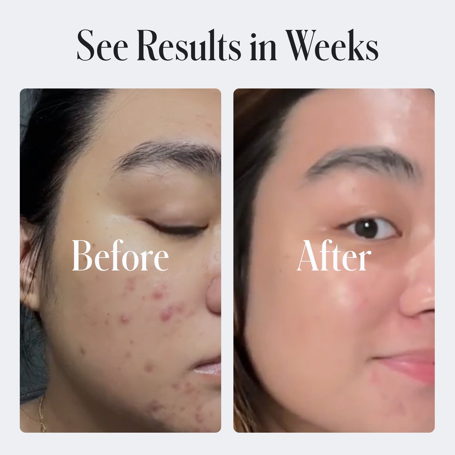 Acne Control Body Wash