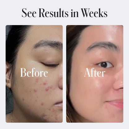 Acne Control Body Wash