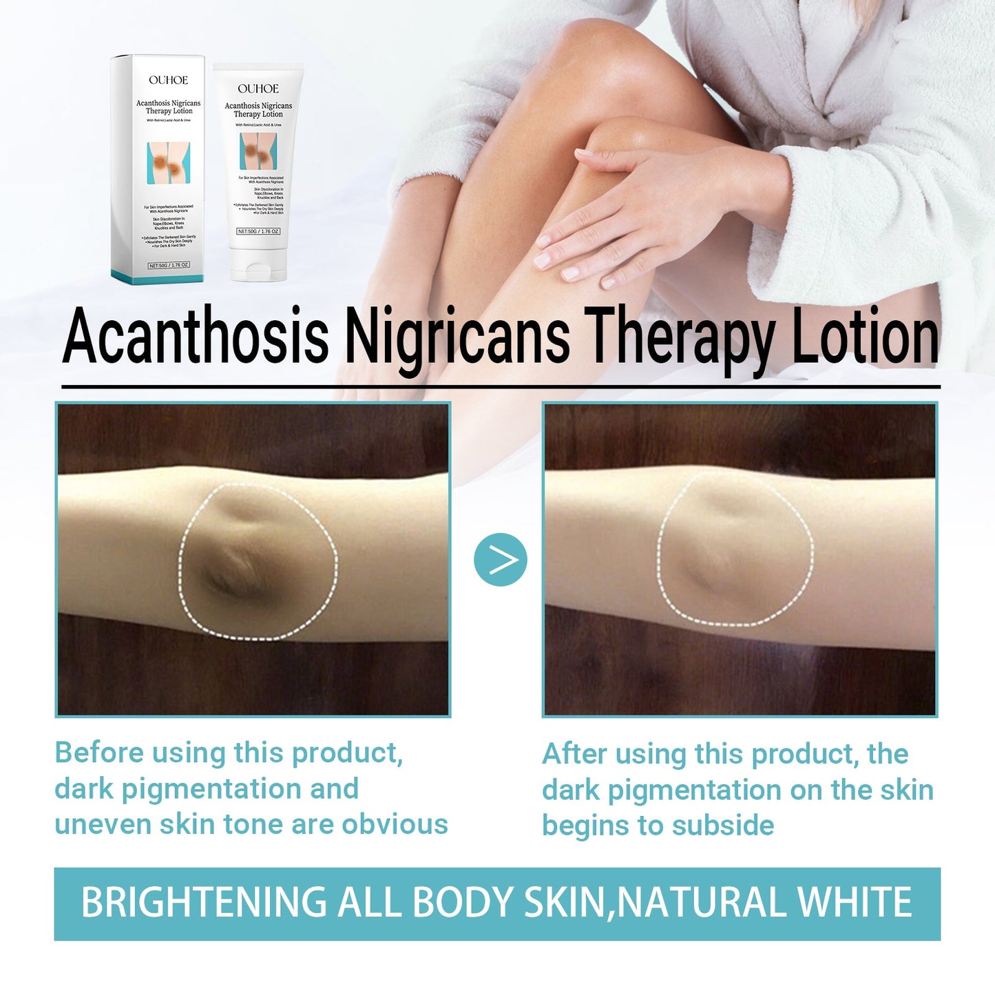 OUHOE Acanthosis Nigricans Therapy Lotion, Skin Moisturizing Clean Black Dark Heavy Alar Knee Joint Repair Carry Bright Color Of Skin