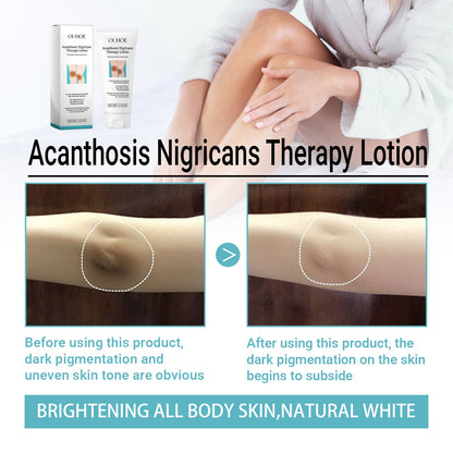 OUHOE Acanthosis Nigricans Therapy Lotion, Skin Moisturizing Clean Black Dark Heavy Alar Knee Joint Repair Carry Bright Color Of Skin