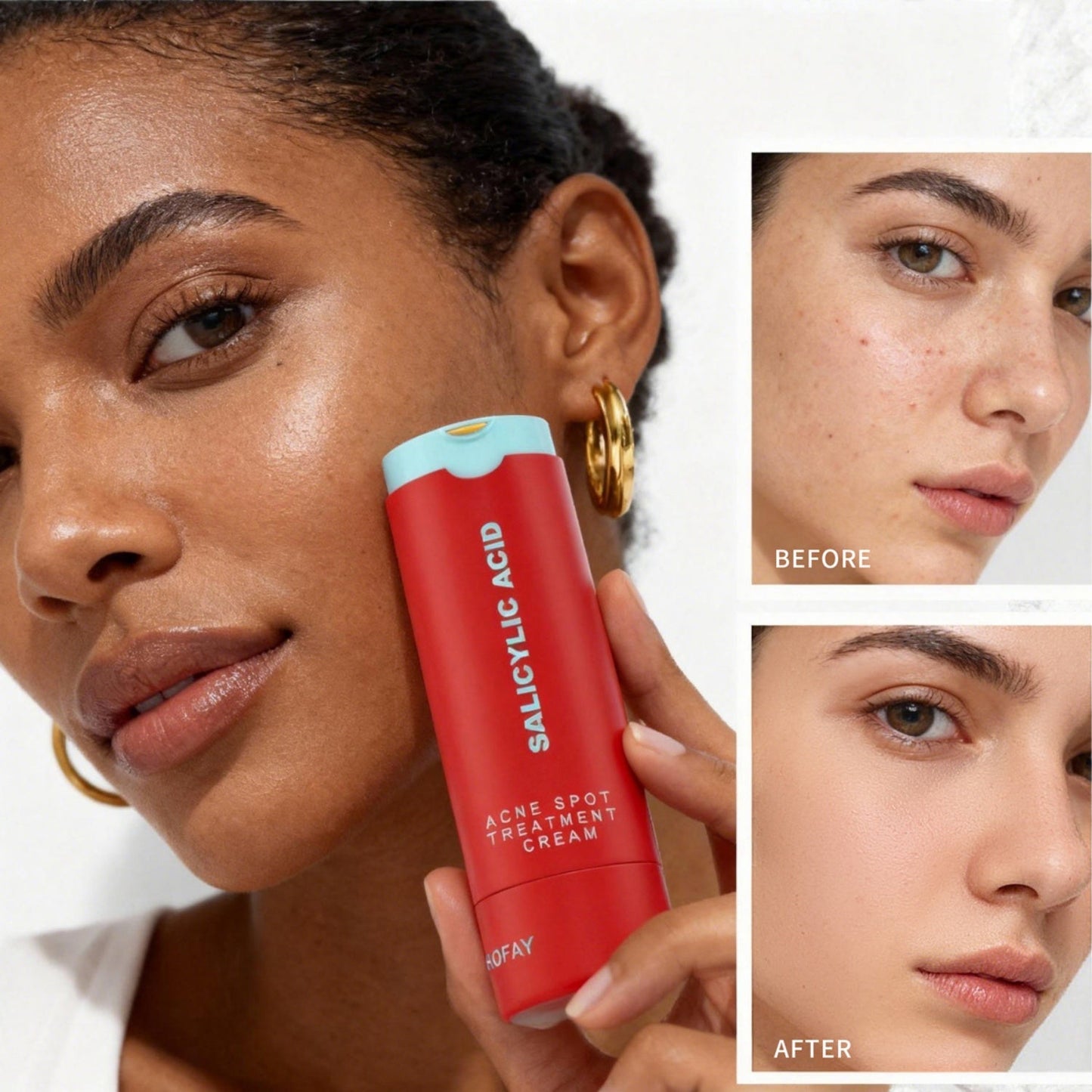 Phofay Acne Removing Lotion