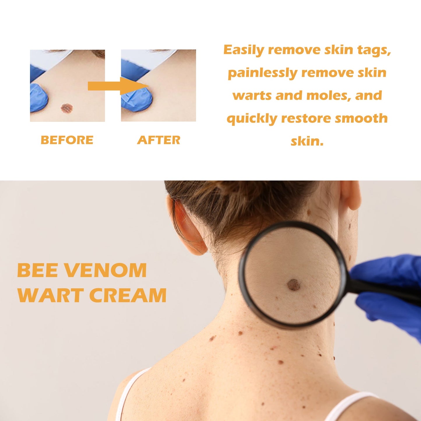 Ximonth Bee Venom Wart Cream, Repair Smooth Skin Lightening Nevus Spot Nevus Cure Wart Care Cream