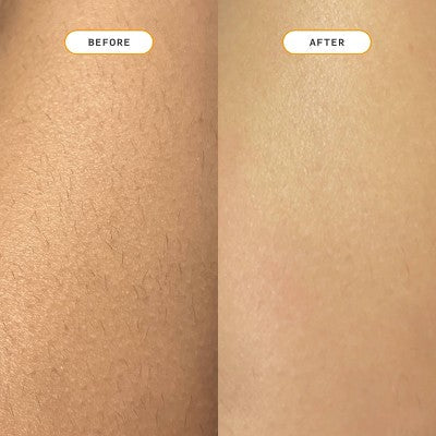 Nood Ingrown Hair Treatment The Eraser - New