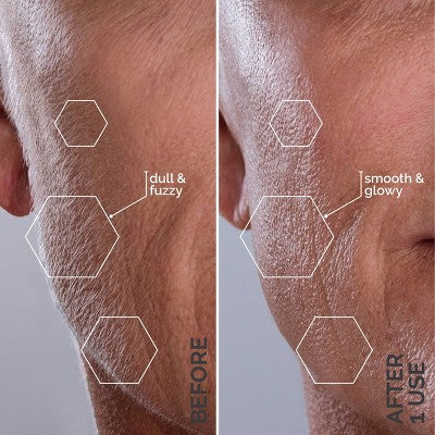 Spa Sciences SIMA Deluxe Sonic Dermaplaning Tool for Exfoliation & Peach Fuzz Removal - Imperfect Box