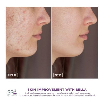 Spa Sciences BELLA 3-in-1 Diamond Tip Microdermabrasion System, with Nano Mist; Pore Extraction - Imperfect Box