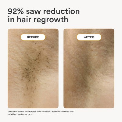 Nood The Flasher 2.0 IPL Permanent Hair Removal - Imperfect Box