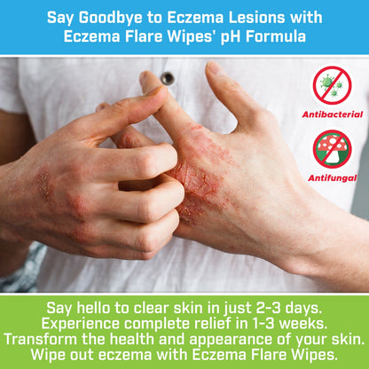 Eczema Flare Wipes®