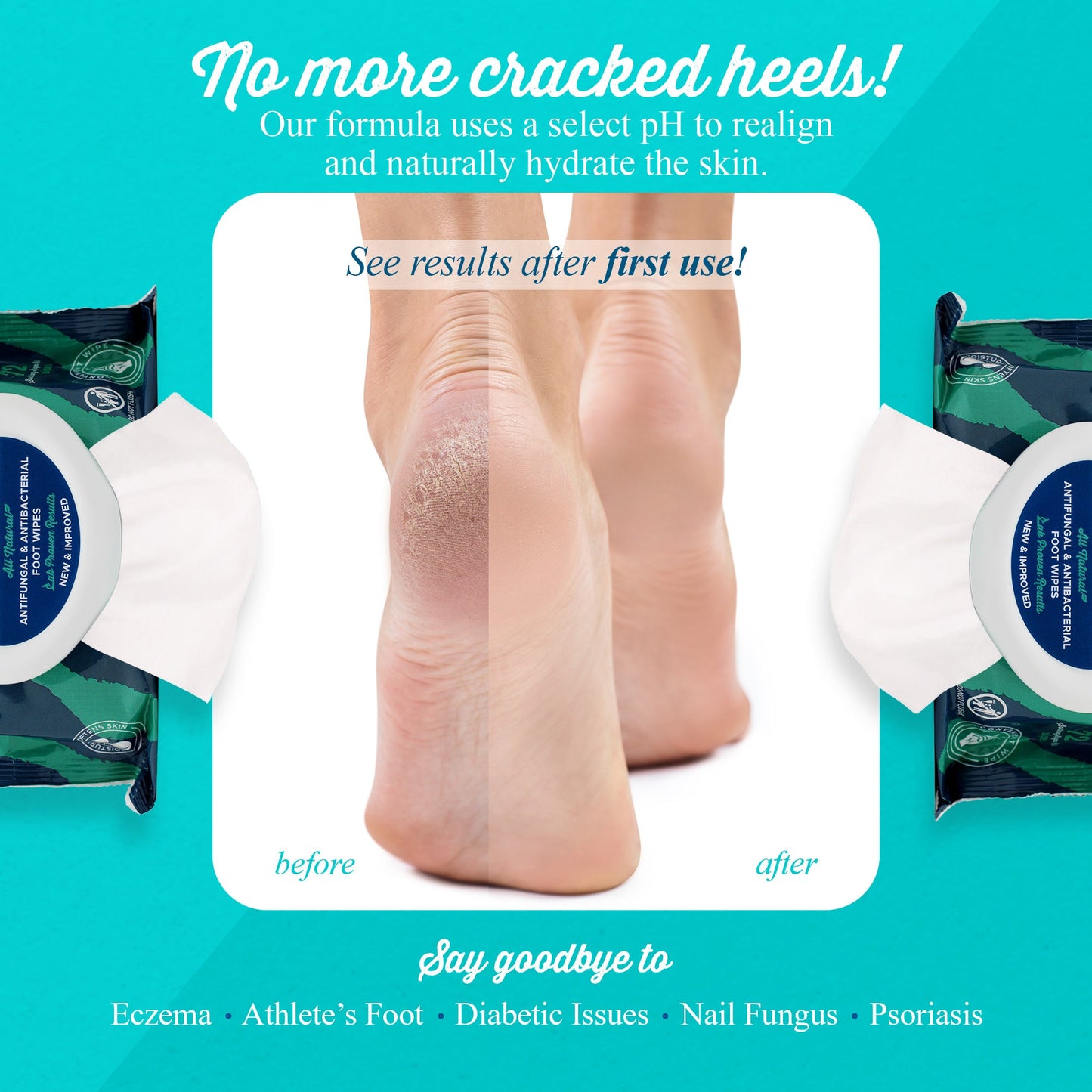 pHeet® Antifungal & Antibacterial Foot Wipes