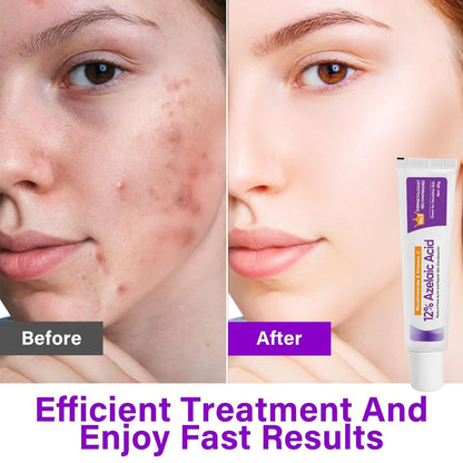 Azelaic Acid Serum, Niacinamide Ointment, Soothing Skin Gel For Fading Acne Scars And Pimples